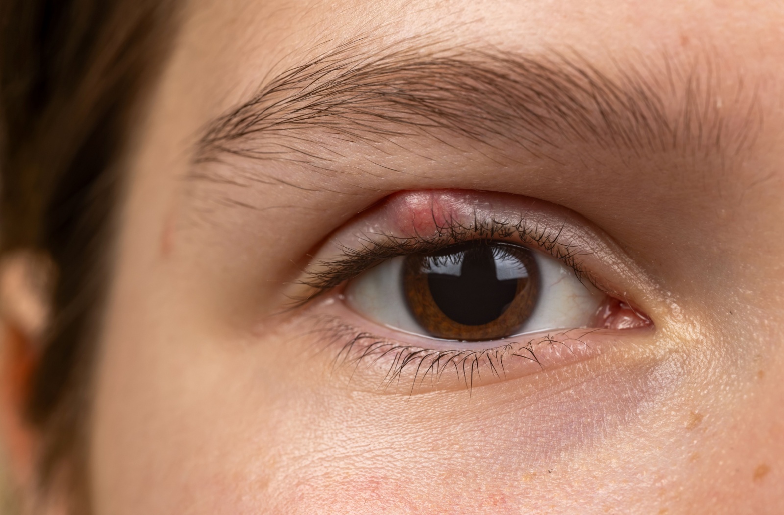 Close-up of an eye with a visible red bump on the upper eyelid, indicating a chalazion.