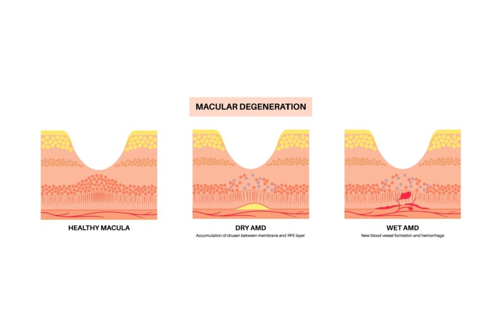 Cross-sectional diagram of the retina showing a healthy macula, dry age-related macular degeneration with drusen buildup, and wet macular degeneration with abnormal blood vessels and bleeding.