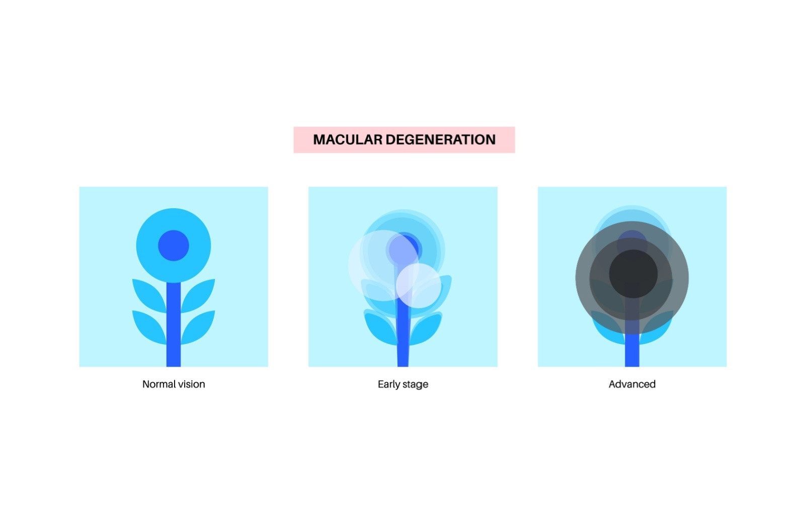 Illustration comparing normal vision, early-stage macular degeneration, and advanced macular degeneration. The first image shows a clear flower, the second shows mild blurring, and the third shows a dark central spot representing vision loss.